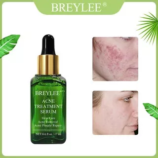 ORIGINAL Breylee Acne Treatment Serum Tea Tree Oil Acne Removal and Pimple Repai 17 ML