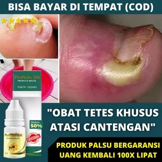 Obat Tetes Kuku Cantengan - Obat Jempol Kuku Cantengan Ibu Jari Kaki Tangan Bengkak Bernanah Berdarah Bau Busuk Kuku Rusak Akibat Jamur Borok Rapuh Menghitam Penumbuh Kuku Mati Bergelombang Psoriasis Bodo Isi Keongan Emtrix Salep Propolis SM Herbal Alami