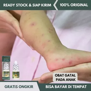 Obat Gatal Anak, Obat Gatal-Gatal Sekujur Badan Anak, Obat Alergi Pada Anak, Obat Budug Anak, Darah Manis, Biduran, Obat Koreng Gatal, Bekas Luka Koreng Anak