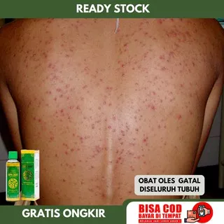 Obat Gatal-Gatal Di Seluruh Badan, Obat Alergi, Obat Gangguan Kulit, Gatal-Gatal Pada Bagian Kaki Tangan Dan Tubuh, Obat Bintik Gatal, Obat Gatal Karena Alergi Eksim Herpes Jamur Jamuran - Bintik Merah Di Badan - Ruam Kulit