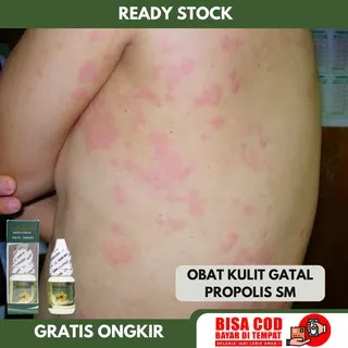 Obat Gatal Menyebar Ke Seluruh Tubuh - Gatal-Gatal Pada Bagian Kaki Dan Tangan - Bintik Gatal - Kulit Sering Gatal - Pruritus - Gatal Karena Alergi Eksim Herpes Jamur Jamuran - Bintik Merah Di Badan - Ruam Kulit - Gatal Kulit Menahun