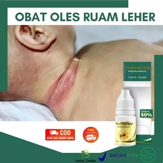 Obat Ruam Leher Bayi -  Lipatan Merah Di Leher Anak - Biang Keringat - Gatal Gatal - Infeksi Jamur - Iritasi - Ruam Merah - Bentol Bentol Kecil - Bentol Berair - Gigitan Hewan - Lecet - Luka - ProPolis SM