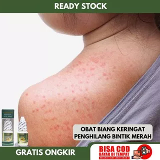 Obat Biang Keringat, Penghilang Bintik Merah, Kulit Gatal Gatal, Bintik Bintik Di Badan, Obat Oles Biang Keringat Anak, Obat Tetes Biang Keringat Dewasa, Obat Gatal Kudis Kurap Panu Kutu Air