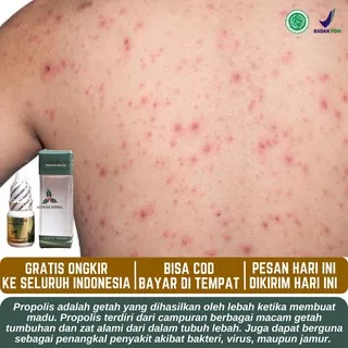 Obat Gatal Di Seluruh Badan, Penghilang Gatal Di Badan, Gatal Di Tubuh, Cacar Air, Cacar Api, Gatal Berair, Campak, Herpes Kulit, Badan Gatal Infeksi Jamur Untuk Anak Dan Dewasa - PROPOLIS SM ASLI