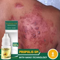 Obat Herpes Genital, Herpes Kelamin, Kulit Cacar, Dompo - ProPolis SM