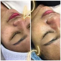 BB Glow Treatment 5x